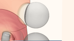 Simulation numérique présentant le collapse de trois bulles