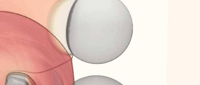 Simulation numérique présentant le collapse de trois bulles
